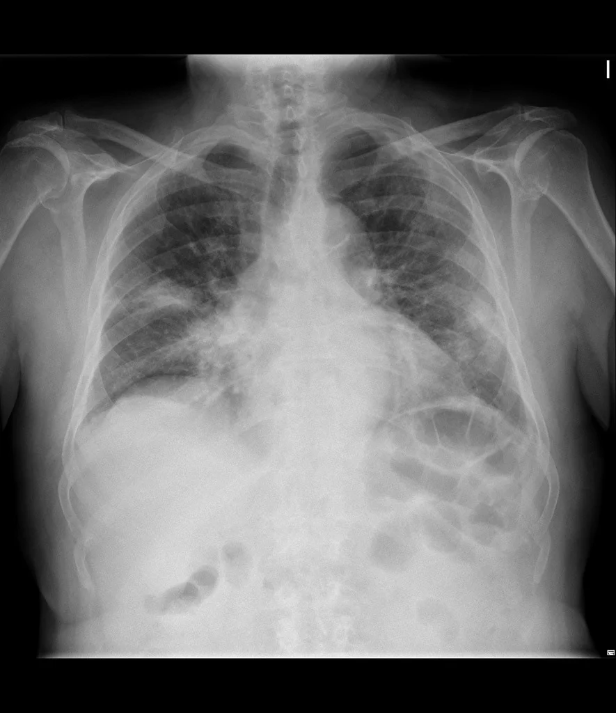 করোনা সংক্রামিত কিনা জানা যাবে এক্স রে রিপোর্টেই! নয়া পদ্ধতি আবিষ্কার মুসলিম বিজ্ঞানীর