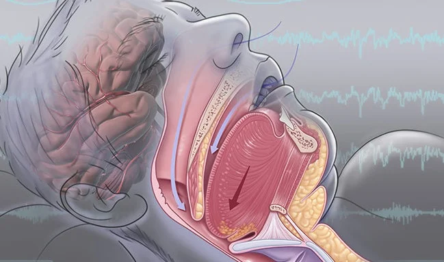 obstructive sleep apneaঃ অবস্ট্রাকটিভ স্লিপ অ্যাপনেয়া-য় চলে গেলেন বাপ্পি লাহিড়ী, কি এই অসুখ জেনে নিন
