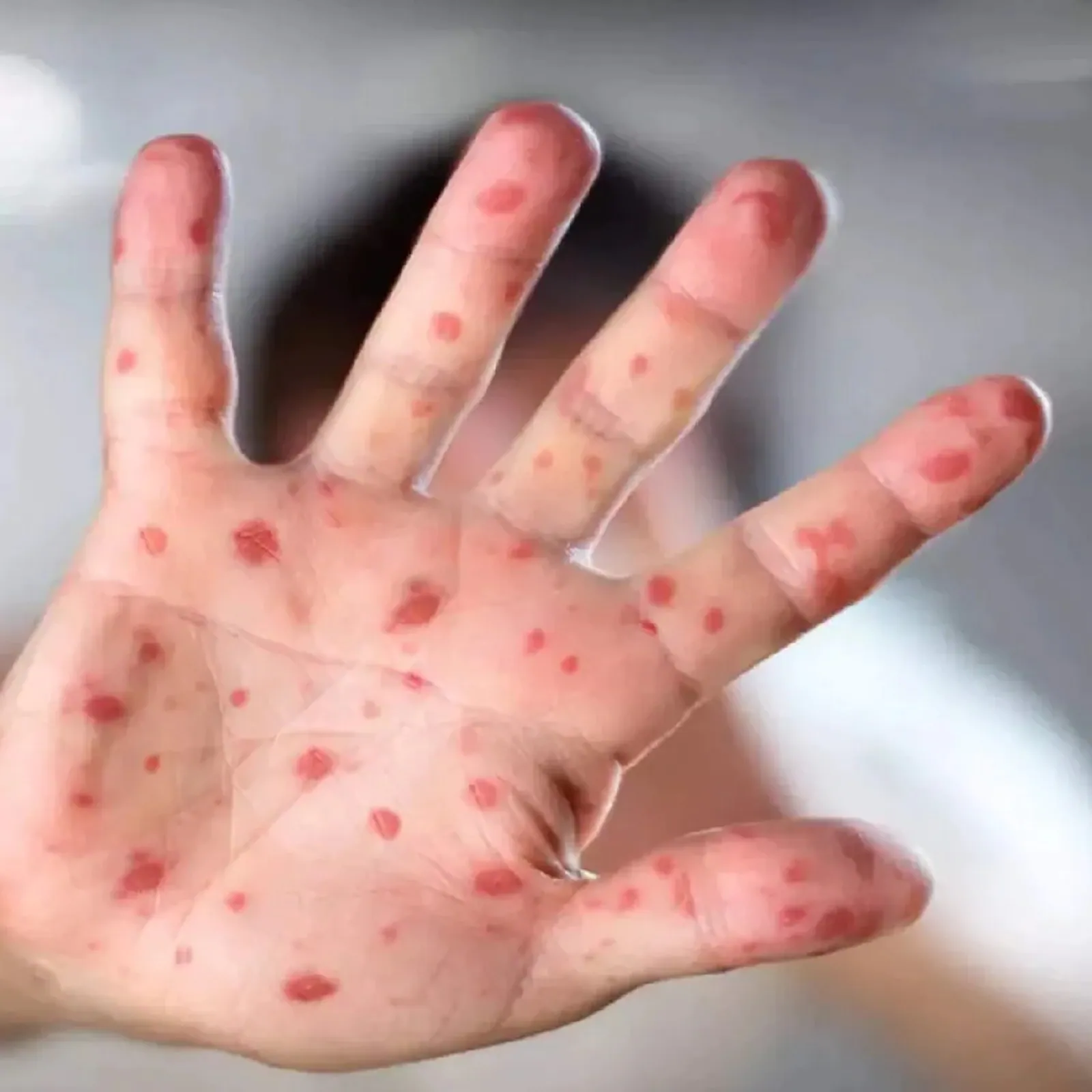 BREAKING: কেরলে মাঙ্কিপক্সে আক্রান্ত আরও ১