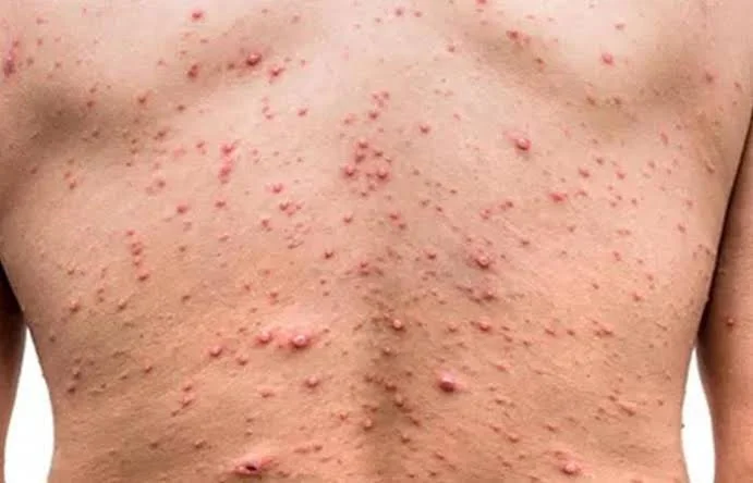 হিমাচলে মাঙ্কিপক্স আতঙ্ক, সন্দেহভাজন ব্যক্তির কোনও বিদেশ ভ্রমণের ইতিহাস নেই