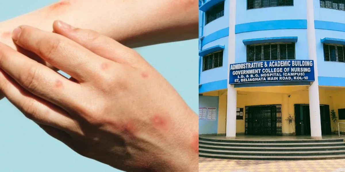 মাঙ্কিপক্স মোকাবিলায় সতর্ক রাজ্য সরকার, জারি নির্দেশিকা, বেলেঘাটা আইডিতে আইসোলেশন বেডের ব্যবস্থা