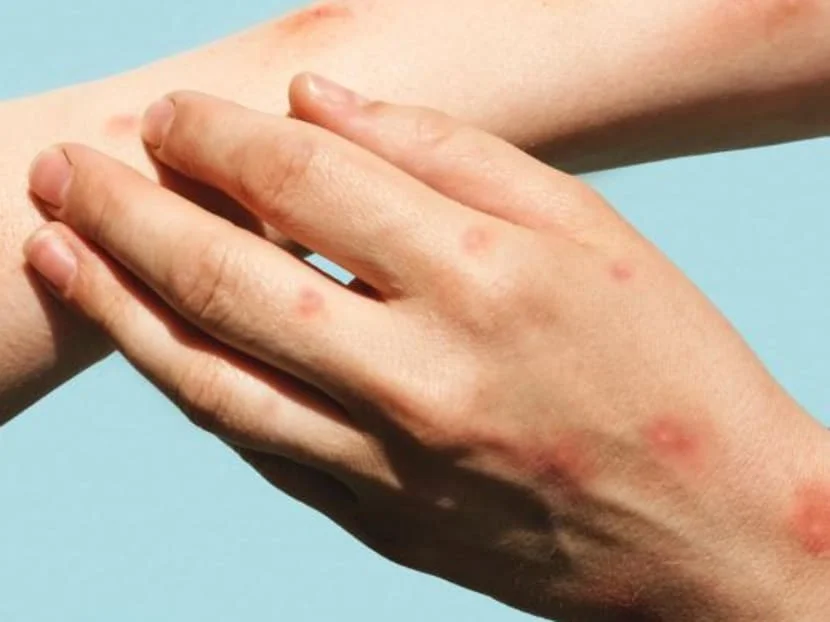 দিল্লিতে সংক্রামিত এক মহিলা, দেশে মাঙ্কিপক্সে মোট আক্রান্তের সংখ্যা ৯