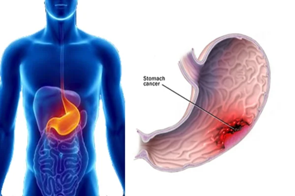 বিবাহিতদের তুলনায় অবিবাহিতদের ক্যানসারের আক্রান্ত হওয়ার প্রবণতা বেশি! জেনে নিন কেন