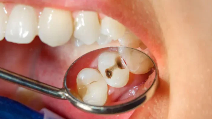 ব্যর্থ দাওয়াই! প্রাচীন টোটকা মেনেই সারিয়ে ফেলুন দাঁতের পোকা