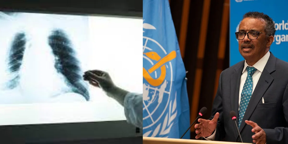 বাড়ছে যক্ষ্মা রোগ! প্রথম ৪ টি দেশের তালিকায় রয়েছে ভারতের নাম, রিপোর্ট পেশ করল 'হু'