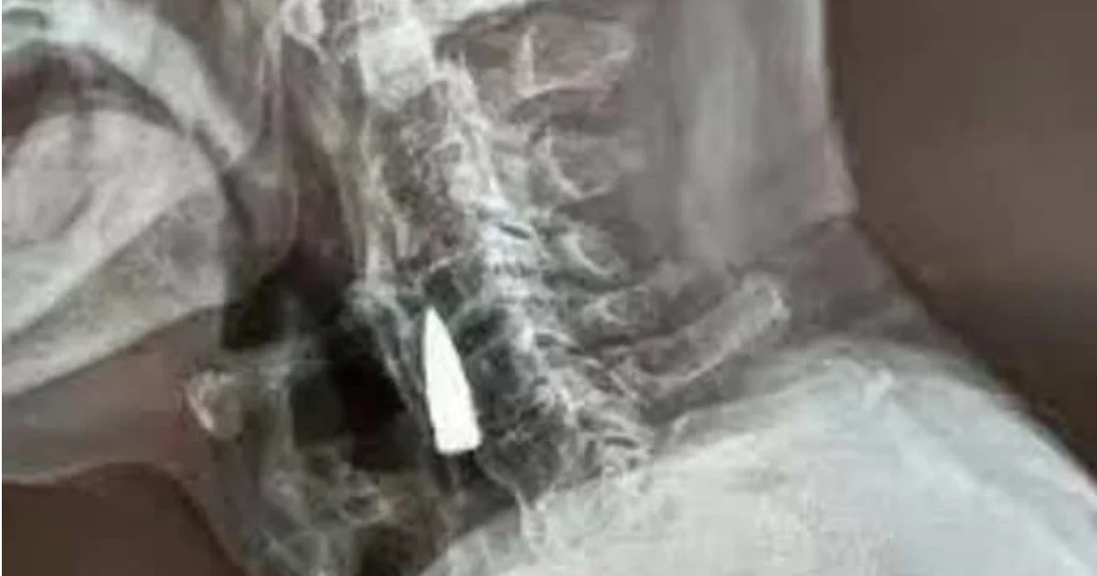 ৭৭ বছর ধরে বৃদ্ধের  গলায় আটকে গুলি !