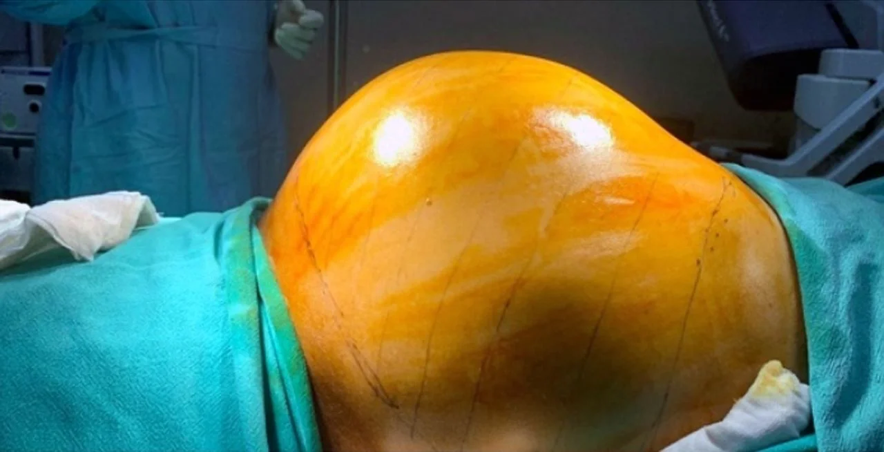 কিডনিতে ১০ কেজি ওজনের ফুটবল আকারের টিউমারের সফল অস্ত্রোপচার হায়দ্রাবাদের হাসপাতালে