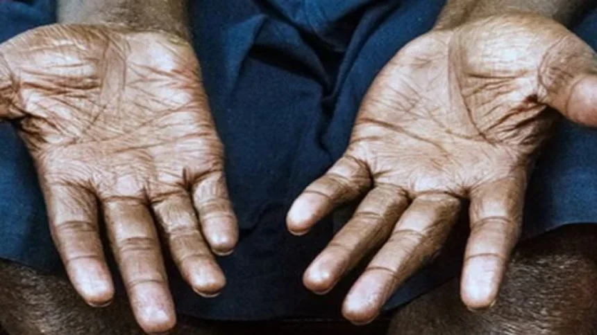 হাম, কালাজ্বর, কুষ্ঠ সহ ৪ রোগ নিয়ে রাজ্যগুলিকে সতর্ক করল কেন্দ্র