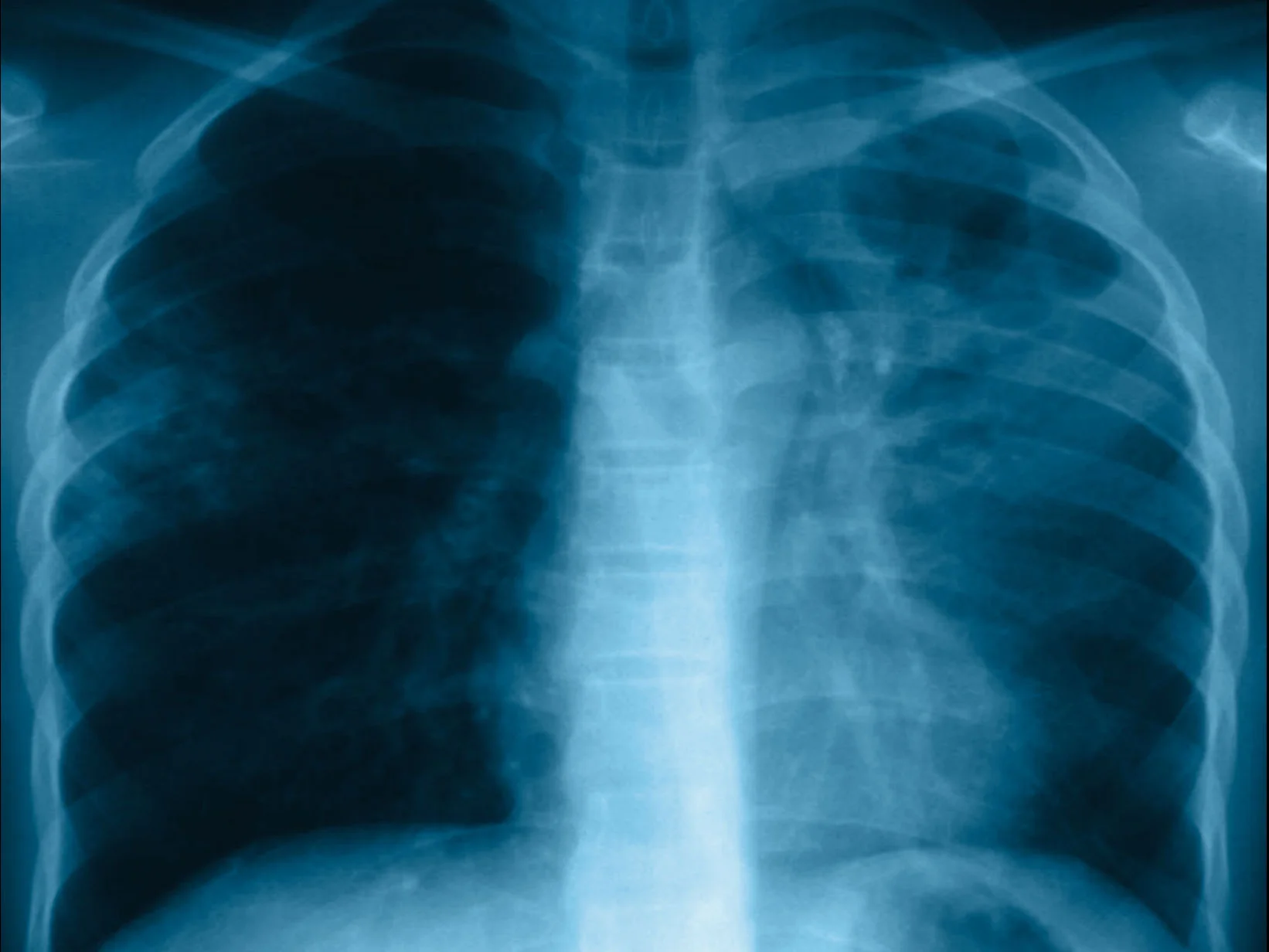 যক্ষ্মায় কলকাতায় ১ বছরে আক্রান্ত ১৩ হাজার, মৃত ২৭২জন