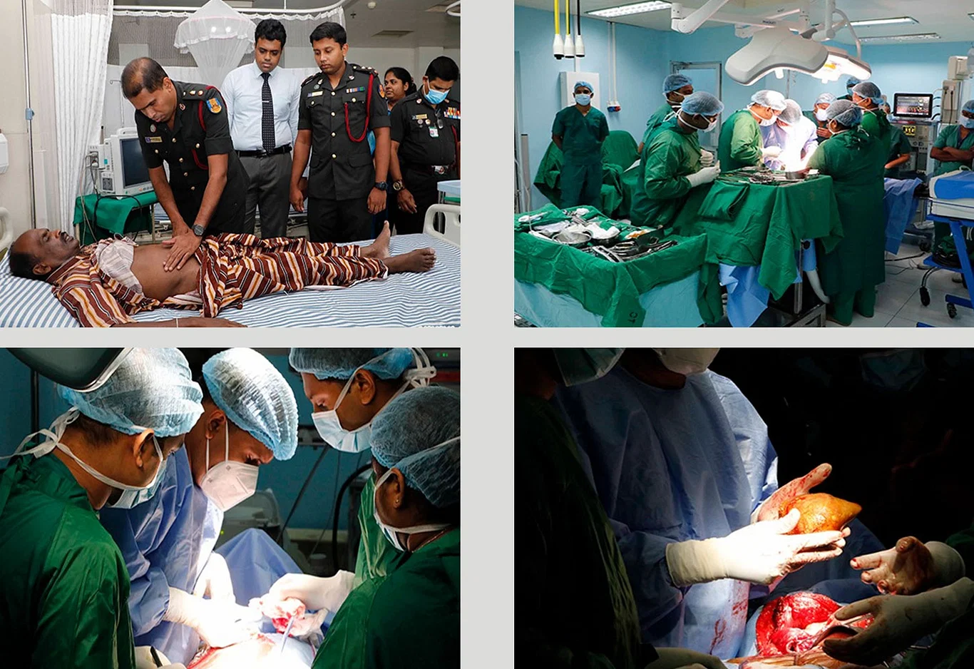 কিডনি থেকে সবচেয়ে বড় পাথর অপসারণ করে বিশ্ব রেকর্ড