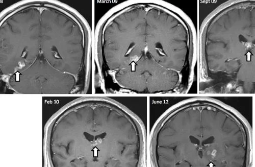 মানুষের মগজে মিলল জীবন্ত কৃমি!