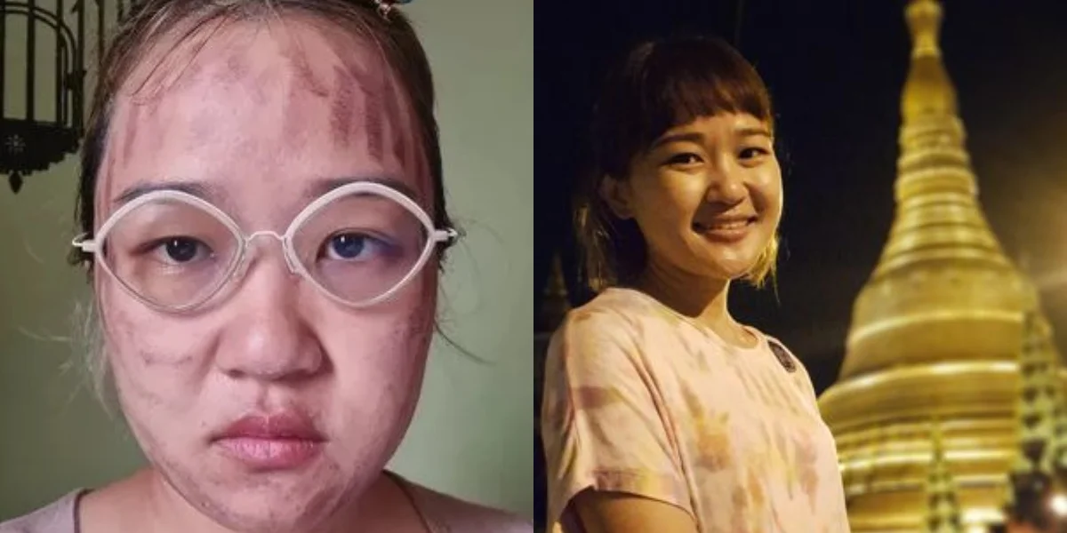 থাই ফেসিয়াল করে ত্বক পুড়ে গেল, বীভৎস টিভি সঞ্চালিকার মুখ