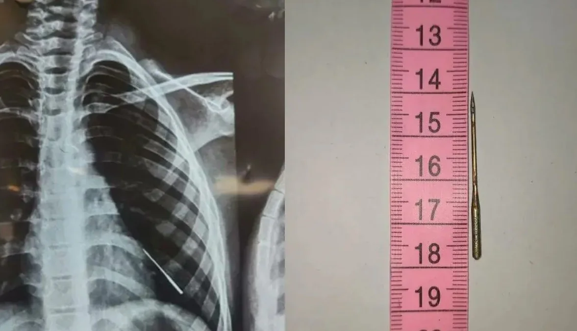 নজির গড়ল ভুবনেশ্বর এইমস, অস্ত্রোপচার ছাড়াই বালকের ফুসফুস থেকে বের করা হল সূঁচ