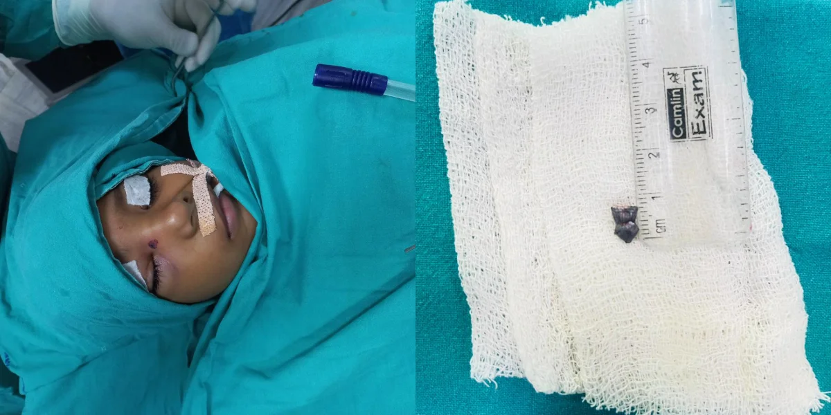 গুলি বের করে শিশুকন্যার দৃষ্টিশক্তি রক্ষা মেডিক্যালে