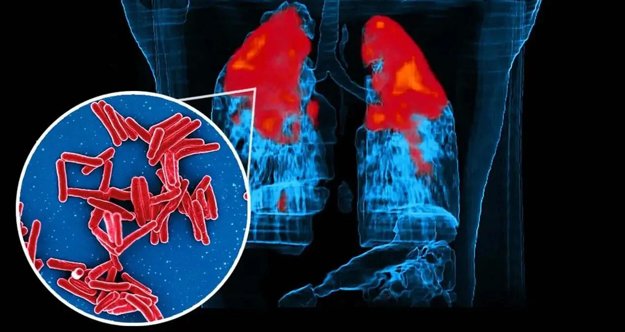 যক্ষ্মা নিরাময়ে ভারতের ভূমিকায় পঞ্চমুখ ‘হু’